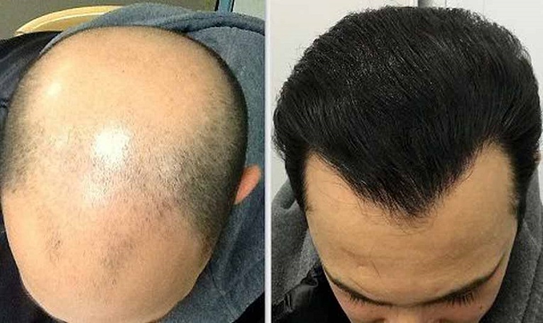 کلینیک کاشت مو طبیعی در شهریار