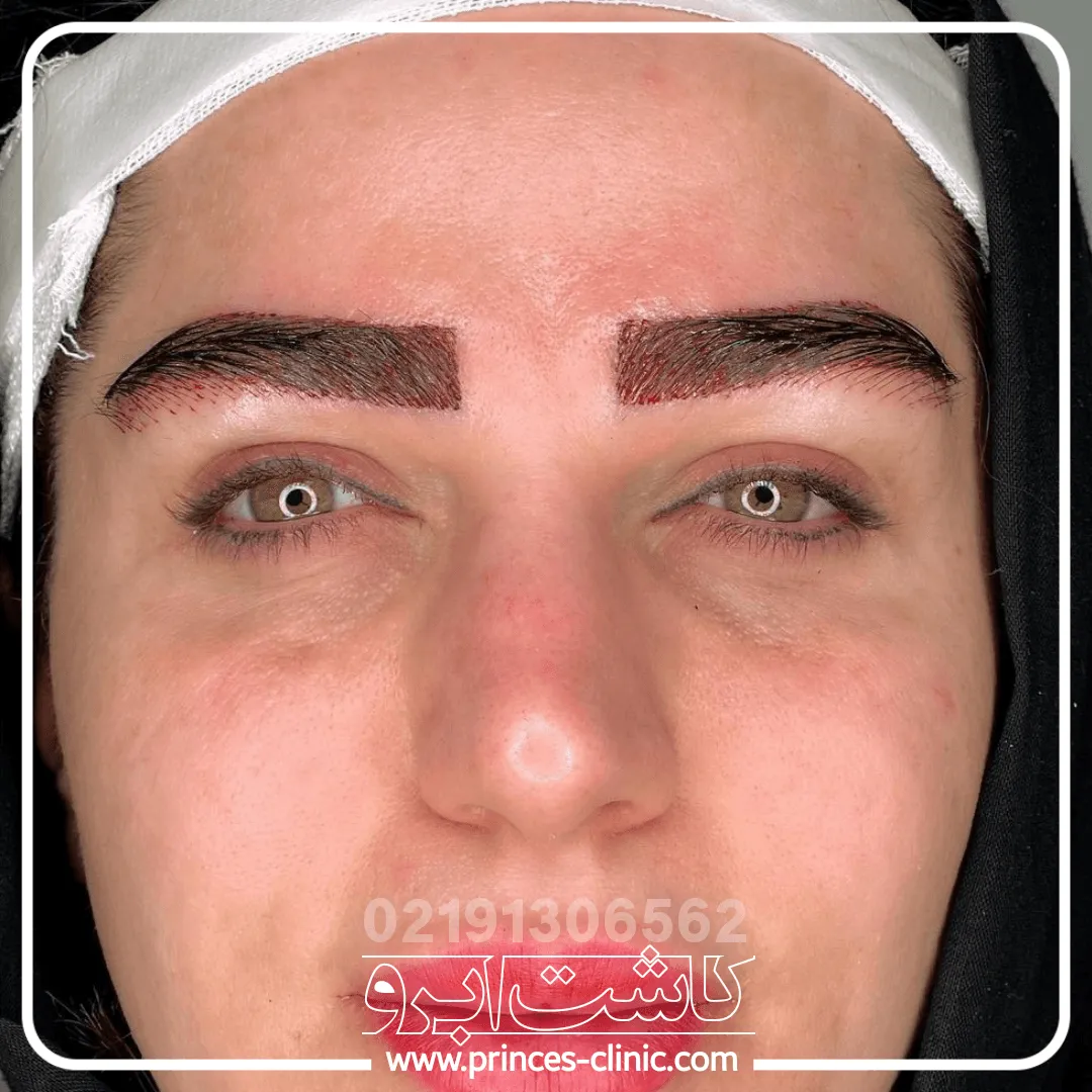 کاشت-ابرو-اندیشه.webp