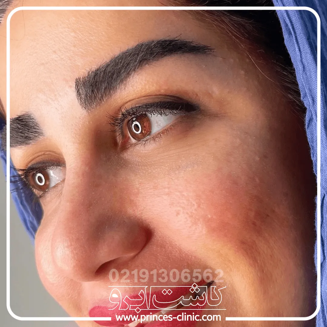 کاشت-ابرو-در-اندیشه.webp
