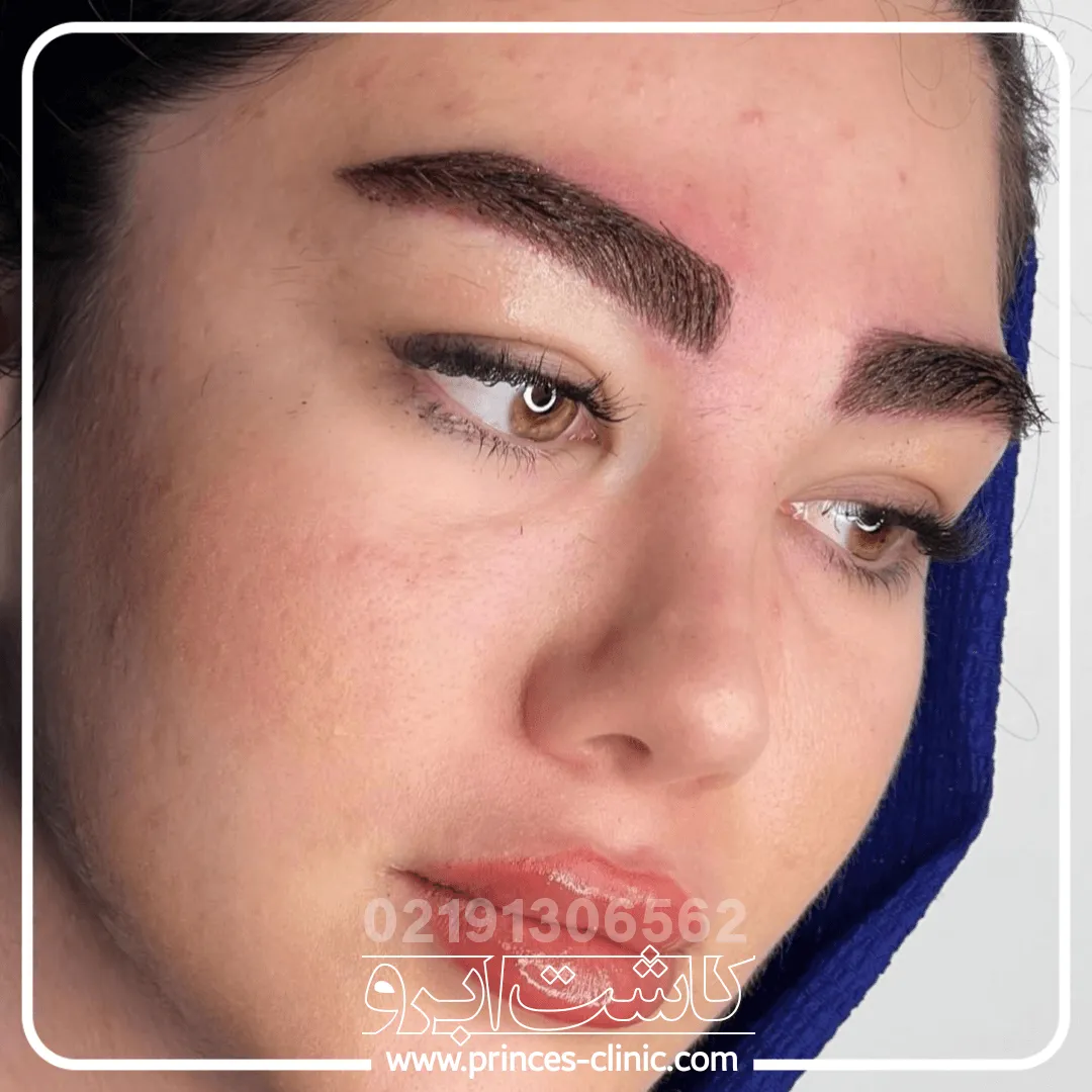 کاشت-ابرو-زیبایی.webp