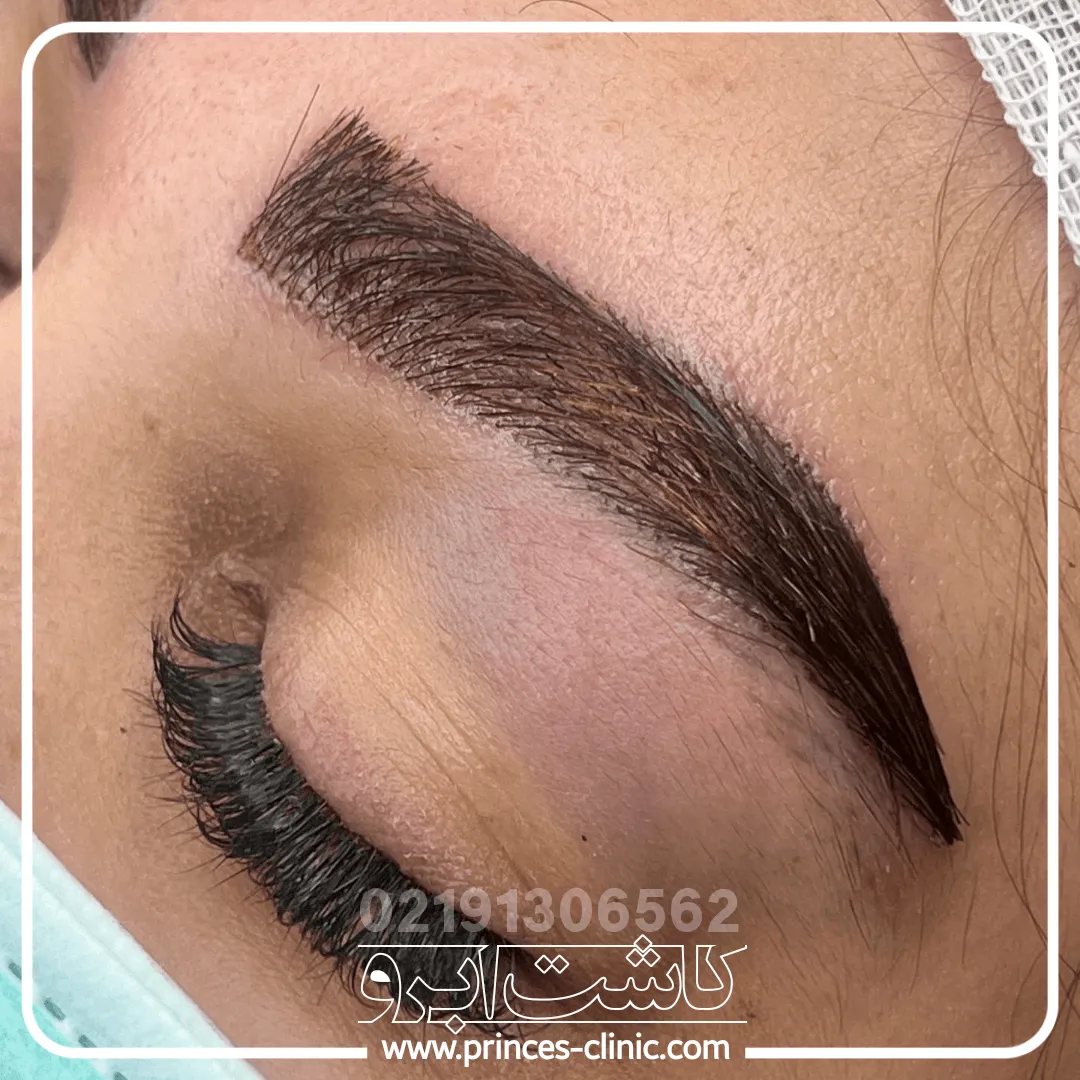 کاشت-ابرو-شهریار.webp