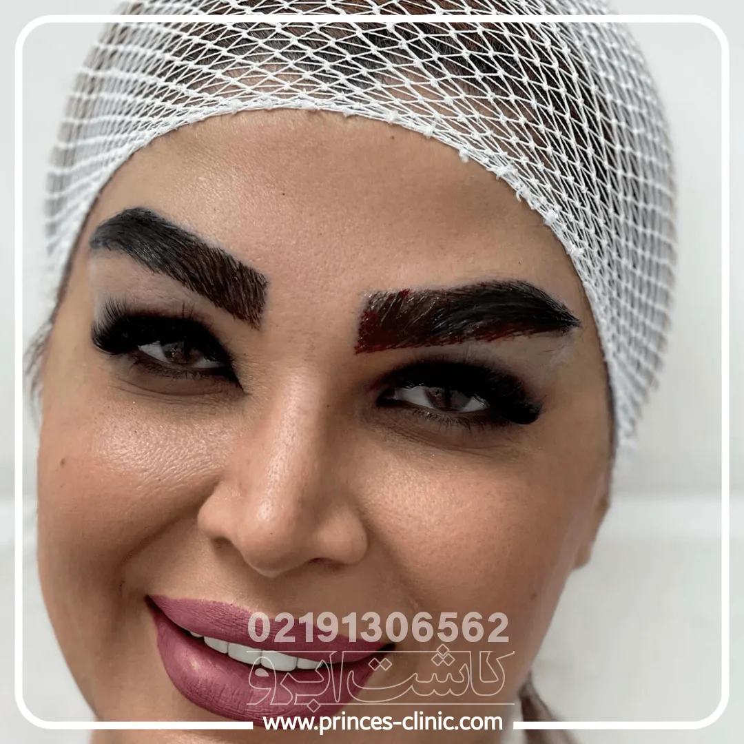 کاشت-ابرو-پرتراکم-اندیشه.webp
