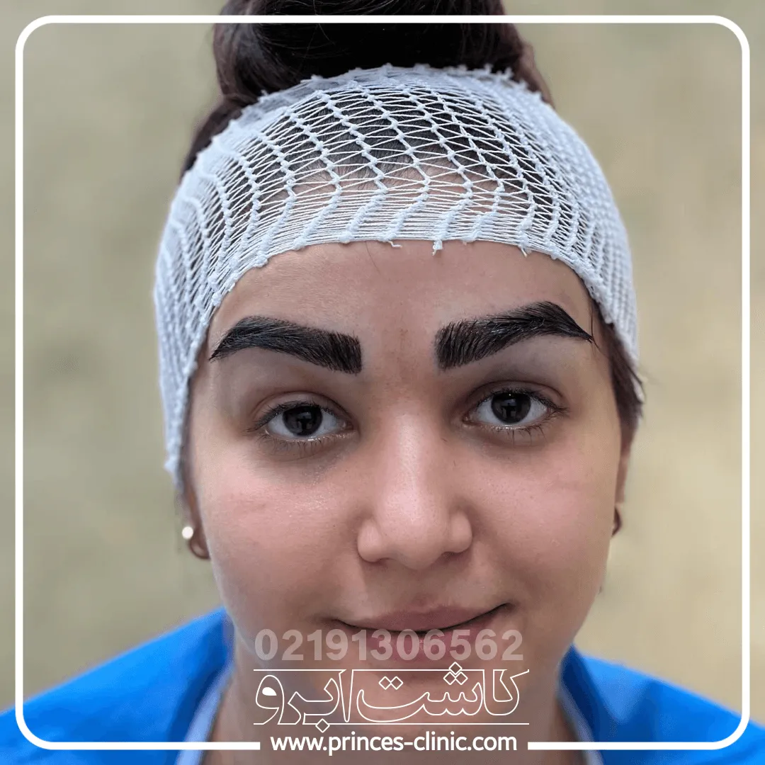 کاشت-ابرو-پرتراکم.webp